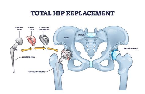 total hip replacement steps orthobullets|Total Hip Replacement .